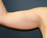 Feel Beautiful - Liposuction right arm - Before Photo